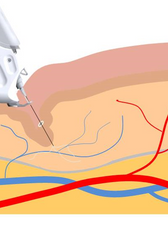 Mesotherapy Gun| Meso Injector| Anti Wrinkle Beauty Device