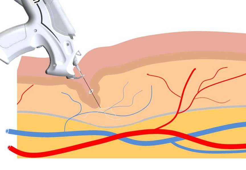 Mesotherapy Gun| Meso Injector| Anti Wrinkle Beauty Device